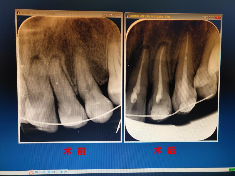 牙槽骨骨折图片图片